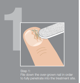 Onychomycosis - Nail Fungus