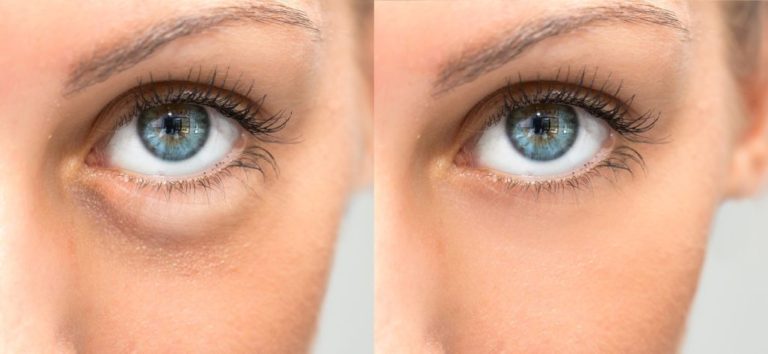 Fotona SmoothEye | Tighten & Reduce wrinkles around the eyes