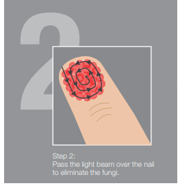Onychomycosis - Nail Fungus