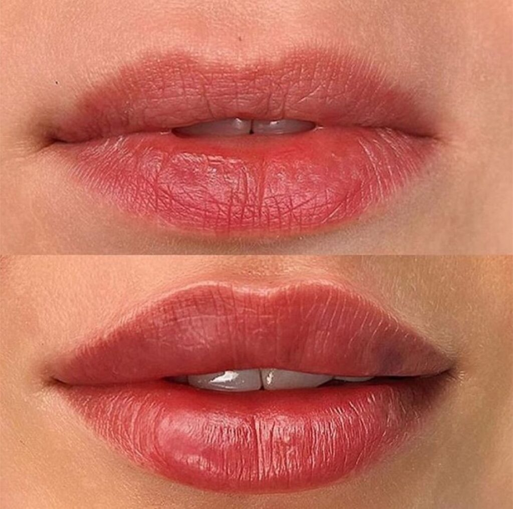 Fotona Liplase Non Invasive Plumping For Fuller Lips