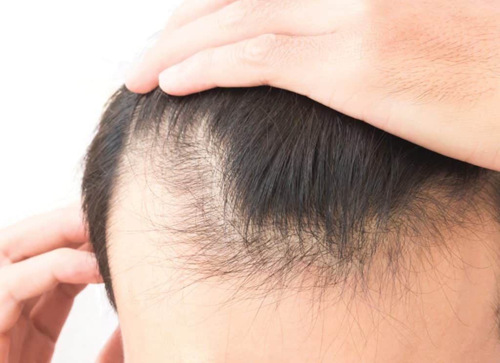 Hairestart - Non-Invasive Laser Stimulation of Hair Growth
