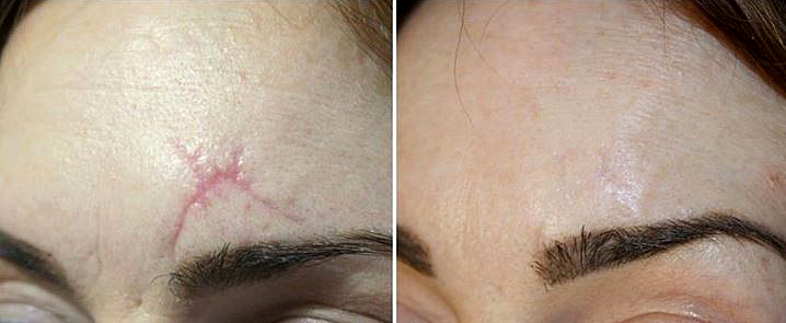 Laser Scar And Striae Treatment