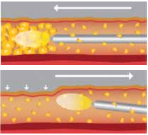 Laser Lipolysis Fats