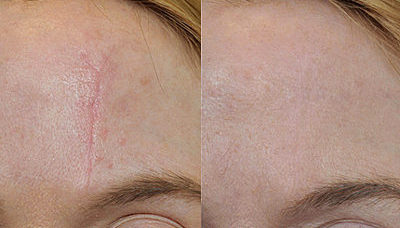 Laser Scar And Striae Treatment