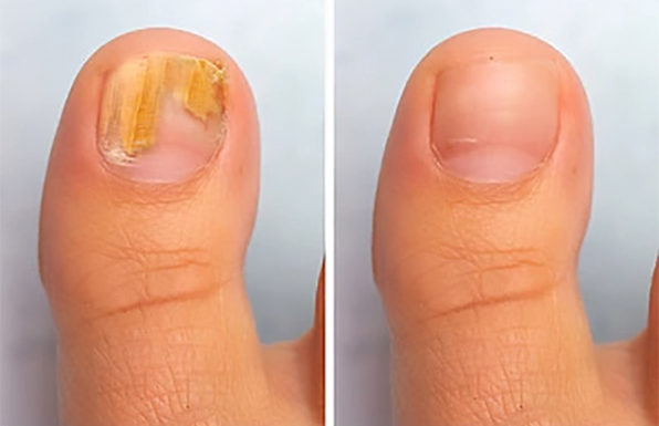 Onychomycosis - Nail Fungus