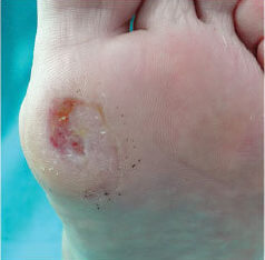 Laser Podiatry - keratosis