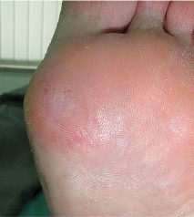 Laser Podiatry - keratosis