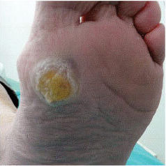 Laser Podiatry - keratosis