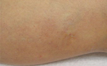 Laser Podiatry - leg veins - Spider veins