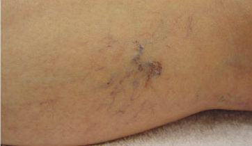 Laser Podiatry - leg veins - Spider veins