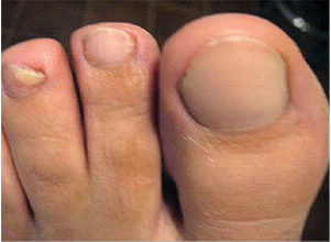 Laser Podiatry - onychomycosis - nail fungus