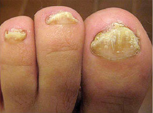 Laser Podiatry - onychomycosis - nail fungus