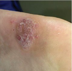 Laser Podiatry - warts