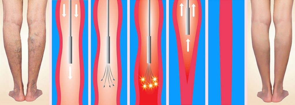 Endovascular Treatment P