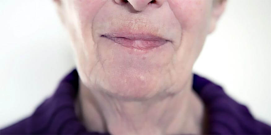 Botox-Chin (to prevent dimpling)