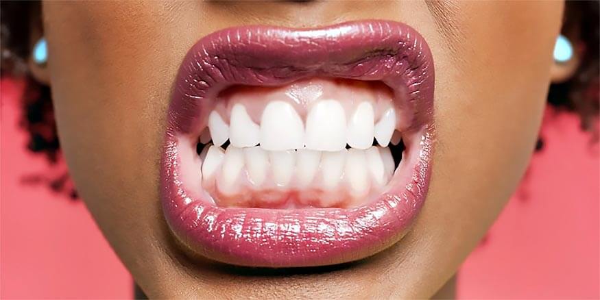 Botox-Jaw angle (teeth grinding – bruxism)
