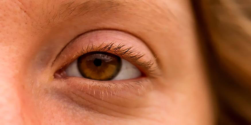 Botox-Under the eyes (tear trough)