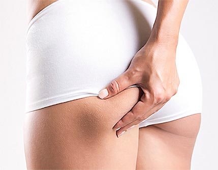 LPG-endermologie-cellulite-Adipeuse-Esteem-Medical-Clinic