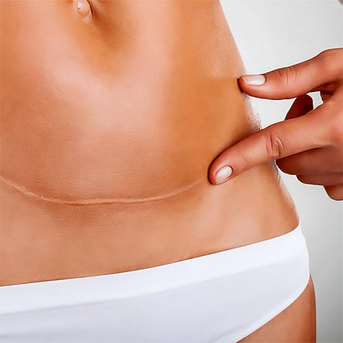 Laser Scar and Stretch marks treatments