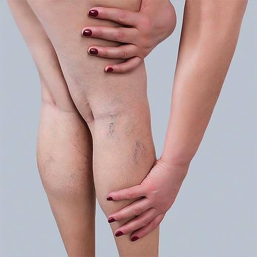 Veins and Vascular Lesions - Best Laser Treatments in Dubai