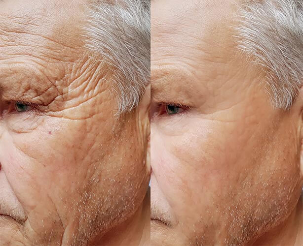 elderly-man-wrinkles-face-before-and-after-botox-esteem-medical-clinic-dubai