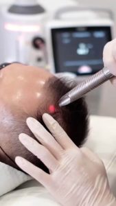 Fotona HaiRestart_Hair Loss Treatment in Dubai